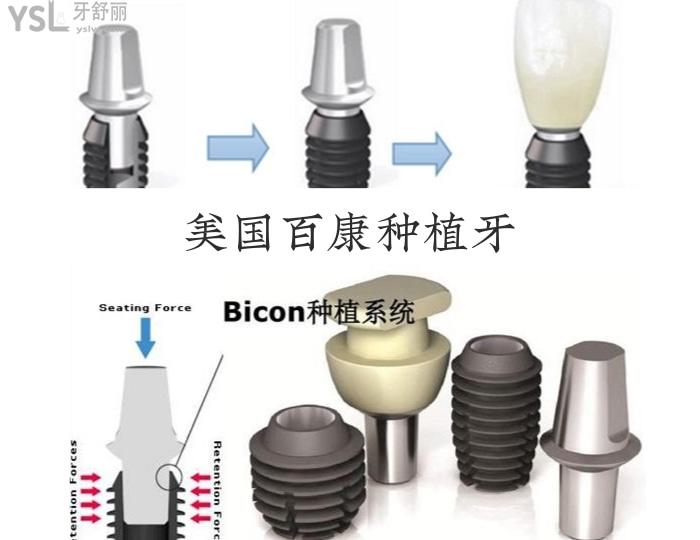 帶你們深扒美國百康種植牙 看看它到底怎么樣.jpg