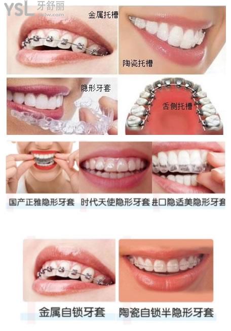 牙套圖片
