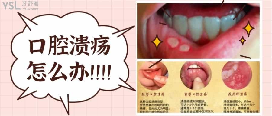 5個小妙招巧治口腔潰瘍
