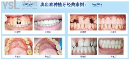 韓國奧齒泰缺點(diǎn).jpg
