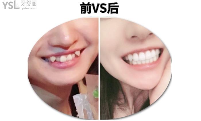 成人盡量不要矯正牙齒？究竟是有風險還是怕你<span style=