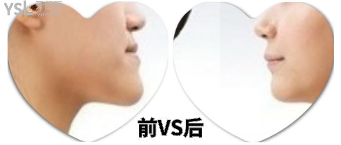 成人盡量不要矯正牙齒？究竟是有風險還是怕你<span style=