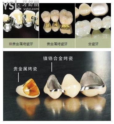 成都烤瓷牙和全瓷牙的價格表