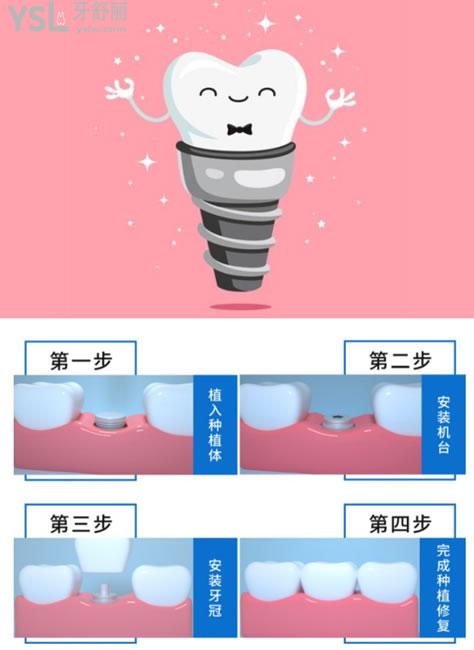 種植牙卡通圖片
