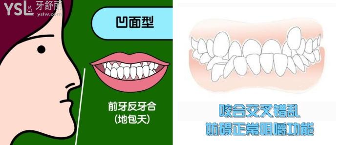地包天不矯正會怎么樣