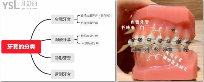 金屬自鎖和陶瓷自鎖哪個好，有哪些牌子求推薦！.jpg