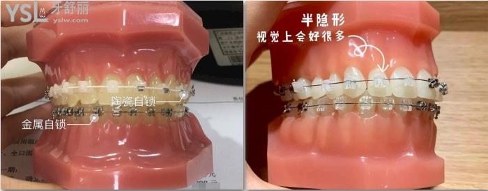 金屬自鎖和陶瓷自鎖哪個好，有哪些牌子求推薦！.jpg