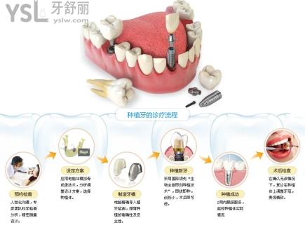 六大國產(chǎn)種植體品牌.jpg