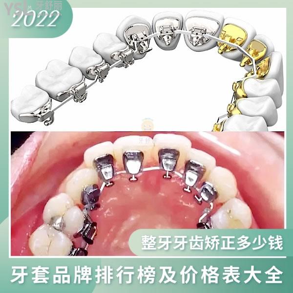 常見(jiàn)舌側(cè)矯正牙套名單及價(jià)格表