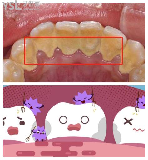 成都洗牙一般多少錢