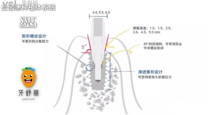 韓國仕諾康和奧齒泰哪個好？看完對比再做種植牙也不遲！.jpg