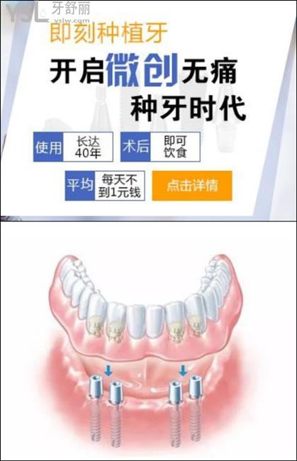 即刻種植
