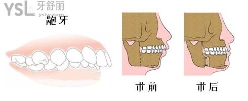齙牙術(shù)前術(shù)后對(duì)比
