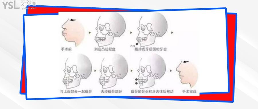 正頜手術是怎么做的