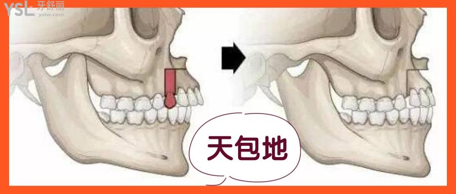 正頜手術是怎么做的