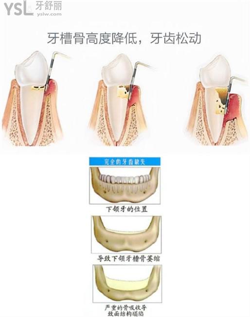 牙槽骨降低