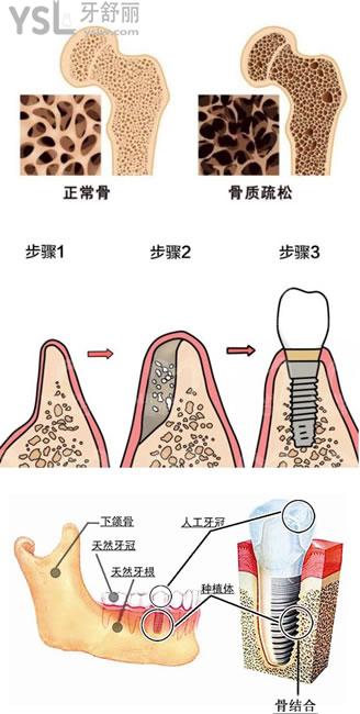 牙齒骨密度圖