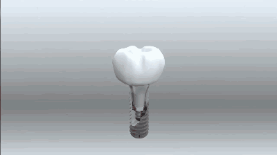 3980元一顆的種植牙質(zhì)量怎么樣