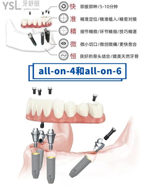 半口牙種植幾顆植體合適，allon4還是6好