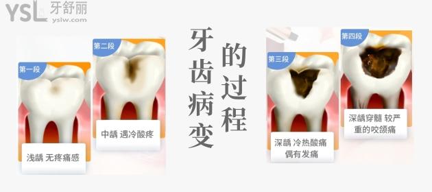牙齒病變的過(guò)程