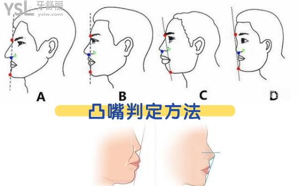 凸嘴判定方法,如何看自己是不是凸嘴?