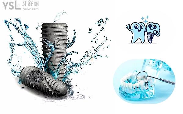 種植牙多少錢(qián)2022別被坑了,真實(shí)種植牙多少錢(qián)一顆2022價(jià)格表
