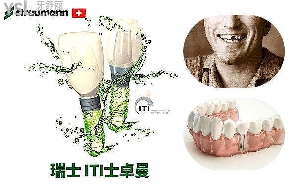種植牙多少錢(qián)2022別被坑了,真實(shí)種植牙多少錢(qián)一顆2022價(jià)格表