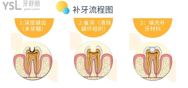 補(bǔ)牙流程圖