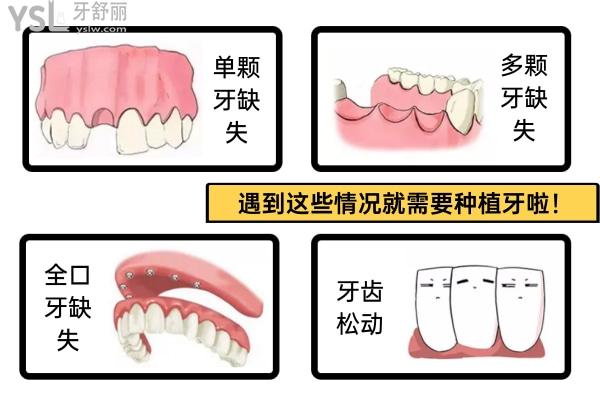 哪些情況需要種植牙？