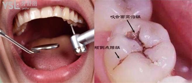成都武侯區(qū)補牙多少錢