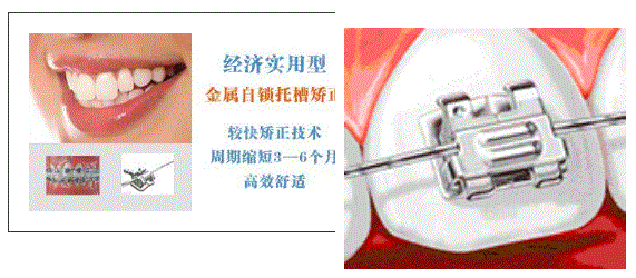 金屬自鎖牙套矯正牙齒的過程