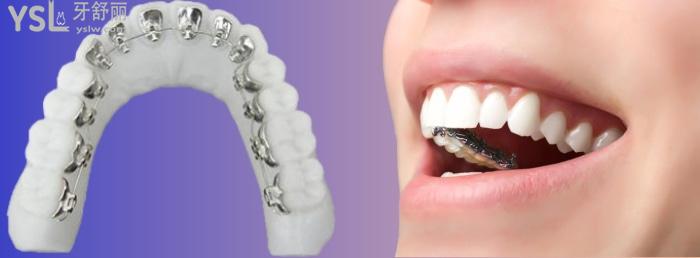 什么是舌側(cè)隱形矯正？做舌側(cè)矯治有啥影響？