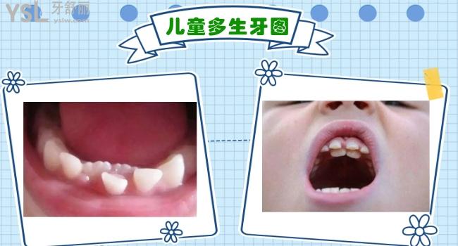 兒童多生牙