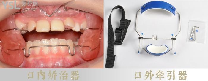 舌側(cè)矯正影響說(shuō)話嗎？如何選擇矯治器呢？