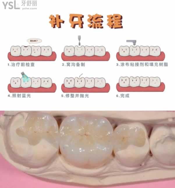 補牙過程圖