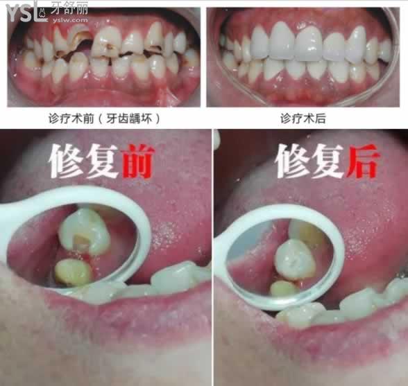 補牙對比圖