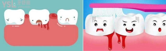 牙齦發(fā)炎了怎么辦？牙齦發(fā)炎能不能自己處理？