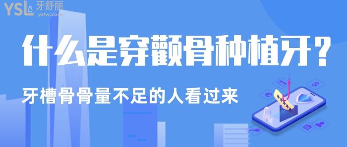 什么是穿顴骨種植牙