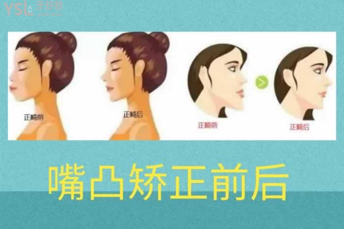 手術(shù)矯正嘴凸一般需要多少錢