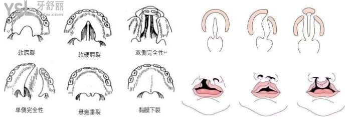 30歲唇腭裂說話不清楚還有治嗎？怎么治？