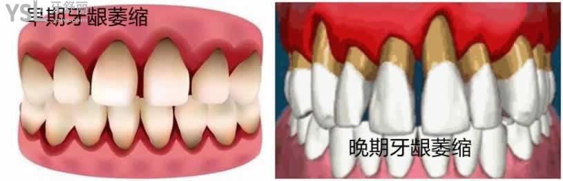 牙齦萎縮圖片及癥狀怎么治療