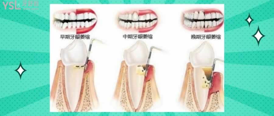 牙齦萎縮圖片及癥狀怎么治療