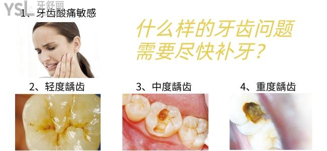 什么樣的牙齒問(wèn)題需要補(bǔ)牙