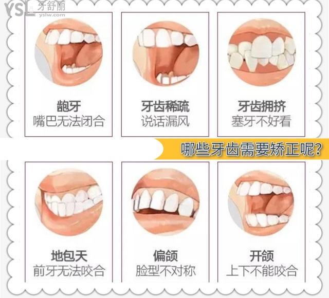 哪些牙齒需要矯正