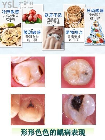 牙體牙髓病的癥狀表現(xiàn)有哪些