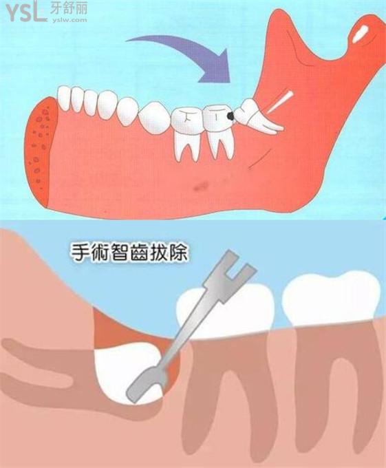 智齒拔除