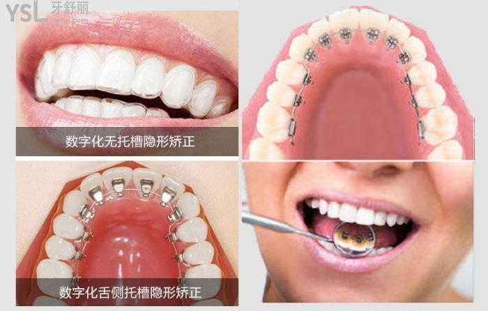 明星們喜歡用的舌側(cè)矯正器很貴嗎？大概多少錢呢？