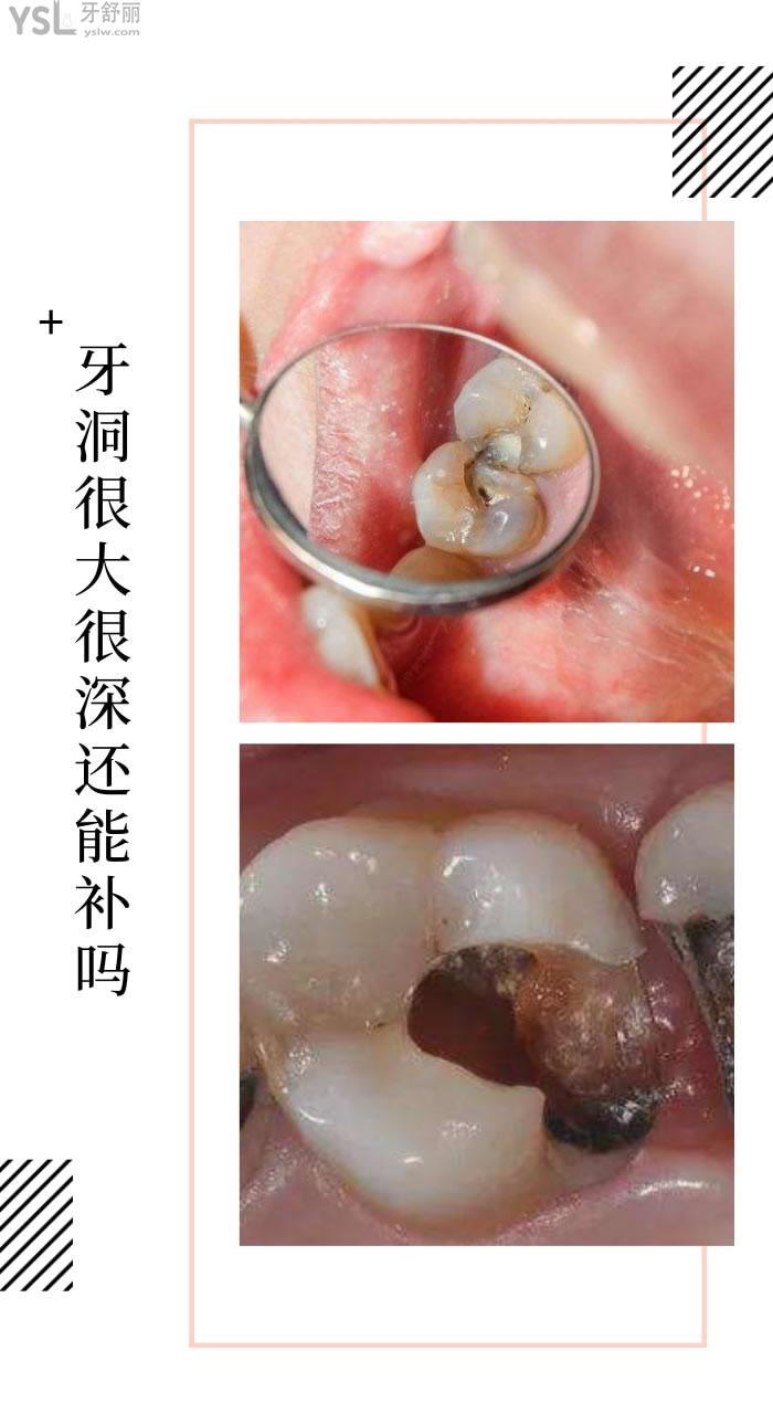牙洞**很深能補嗎