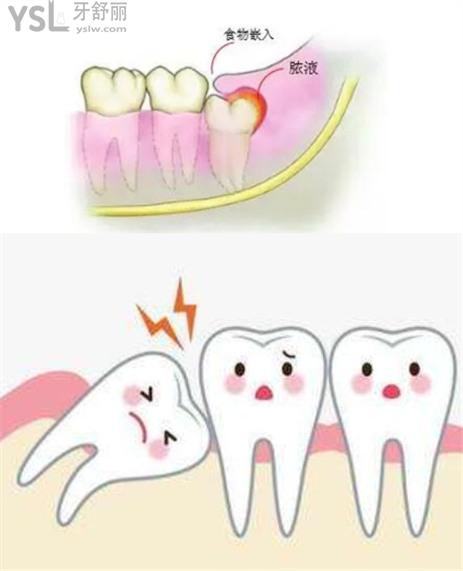 拔智齒