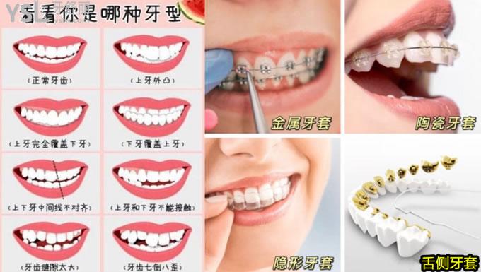 牙齒矯正的類型